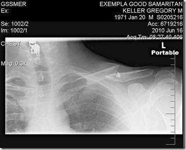 keller clavicle keller clavicle